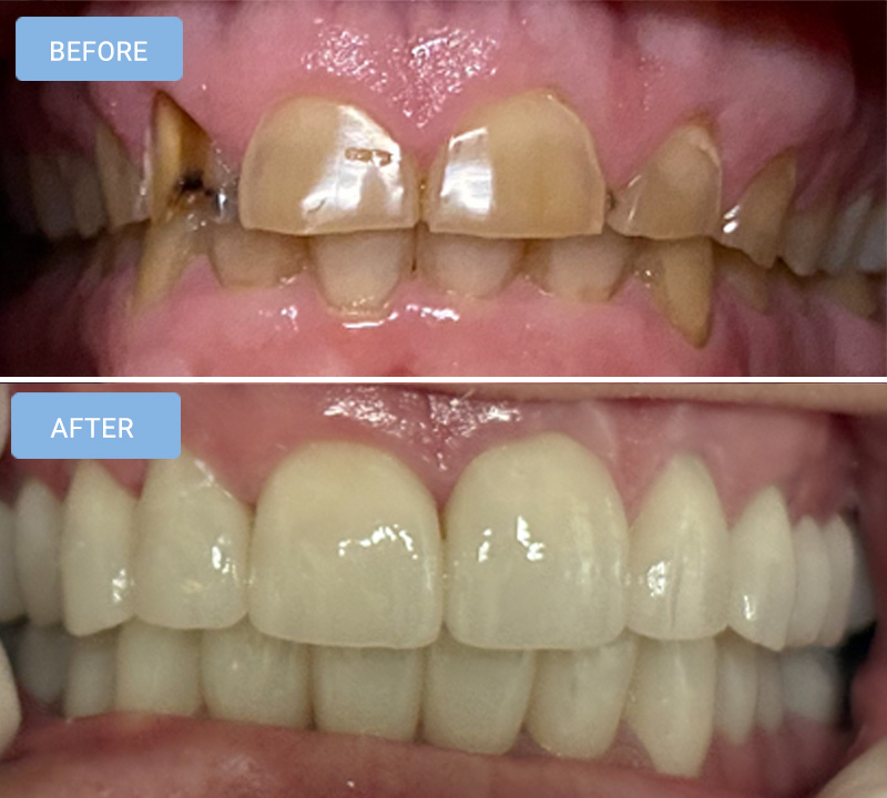 Dental Crowns in Albemarle