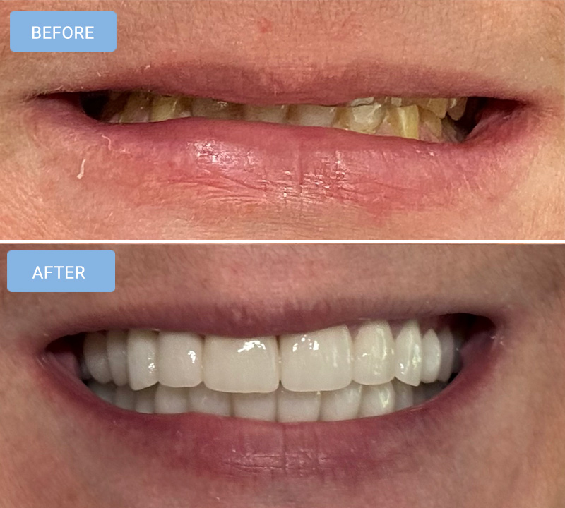 Dental Crowns in Albemarle