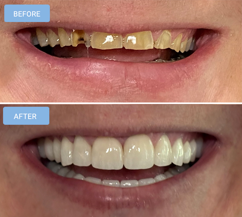 Dental Crowns in Albemarle