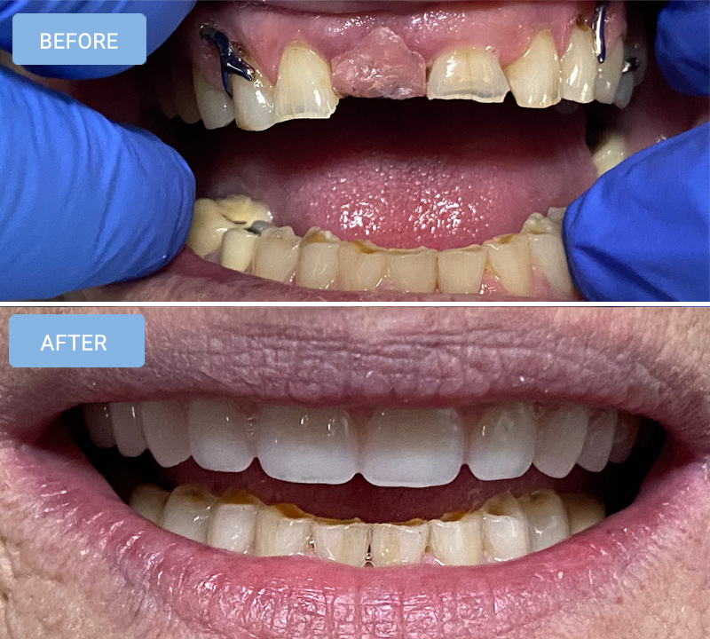 Dentures in Albemarle